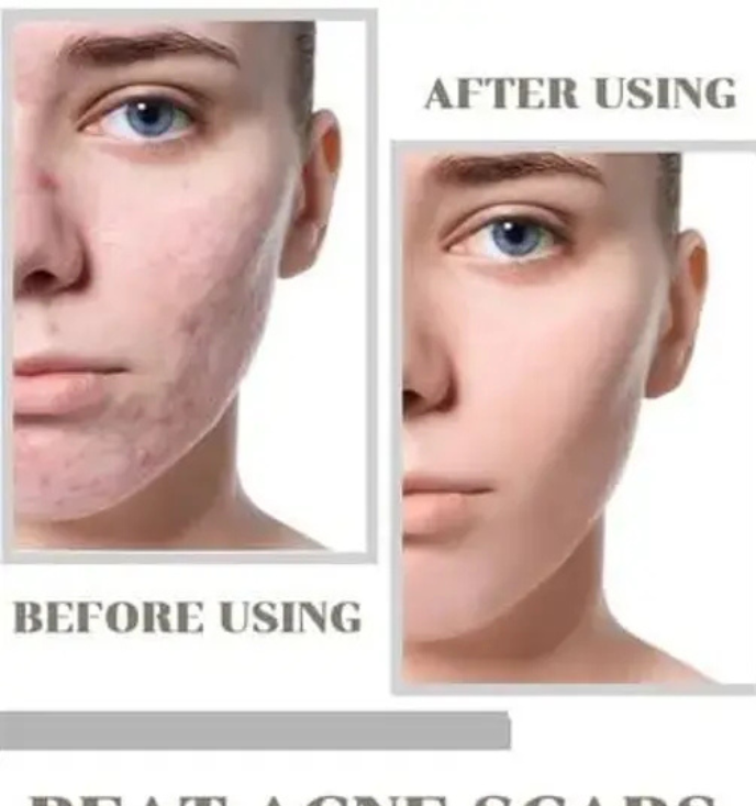 Niacid Face Serum | For Acne Marks, Dark Spots & Pitted Scars